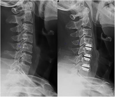 Sagittal sequence and clinical efficacy of cervical disc replacement and hybrid surgery in the treatment of cervical spondylotic myelopathy: a retrospective study